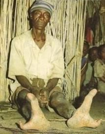 Born only two toes! Africa