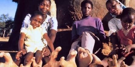 Born only two toes!  Africa 